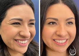 crows feet botox before and after