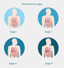 Mesothelioma treatment options (traditional and new treatments being studied). Pin On Mesothelioma Treatment In Toronto