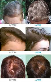 It helps to combat hair loss and improve the volume and appearance of hair. Laser Hair Therapy Hair Growth Syracuse Ny Profiles By Kristin