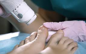 fungal nail treatment the chelsea