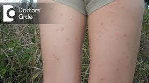 inner thigh rashes in agers