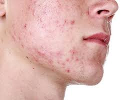 your acne