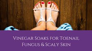 vinegar soaks for toenail fungus