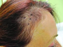 hair loss and the pill siowfa15