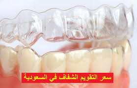 سعر تقويم الاسنان في السعودية