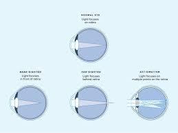 refraction eye exam what is it