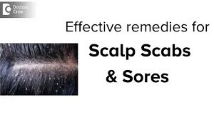 scabs sores on scalp treatment