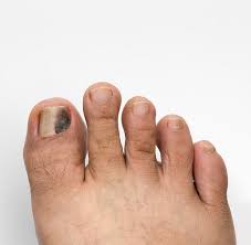 runners get black toenails