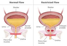 definition facts of urinary retention