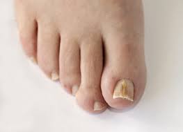 signs symptoms of fungal toenails