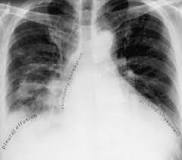 Image result for icd 9 code for acute on chronic hypoxic respiratory failure