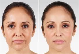 reduce swelling after lip fillers