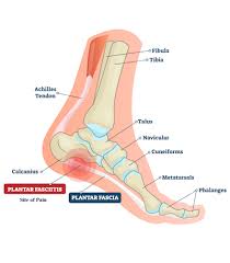 plantar fasciitis back in action