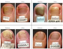 laser treatment for nail fungus