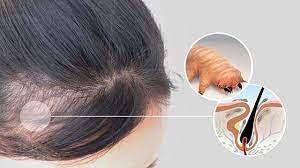 alopecia and demodex mites