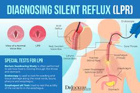 silent reflux symptoms causes and