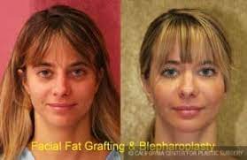 fat transfer for lip augmentation