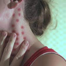 heat rash ly heat types causes