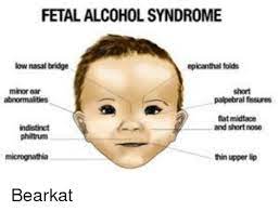 fetal alcohol syndrome low nasal bridge