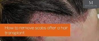 remove scabs after hair transplant