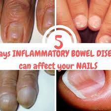 5 ways ibd can affect your nails a