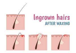 how to avoid ingrown hairs from