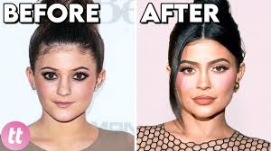 after plastic surgery