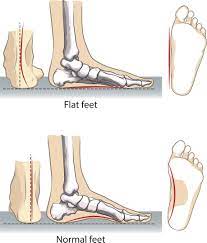 chart of the difference between flat feet and normal feet