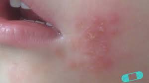 atopic eczema dermatology