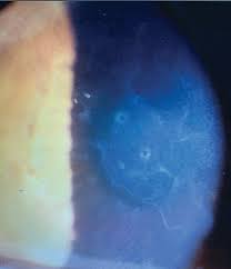 Cataract Surgery After A Phakic Iol