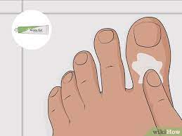 heal a bruised toenail quickly