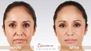 how long does juvederm last advanced