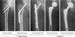 hip fracture the choice of surgery