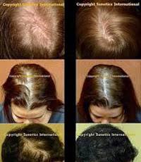 This allows the proper nutrients and oxygen levels to reach the scalp and support a healthy head of hair. Low Level Laser Therapy Lllt For Hair Loss Ava Laser Clinic