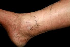 vein conditions that cause leg pain