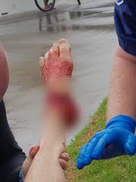 His surfboard wasn't quite so lucky. Surfer 60 Bitten To The Bone In Shark Attack At Windang South Of Wollongong Abc News