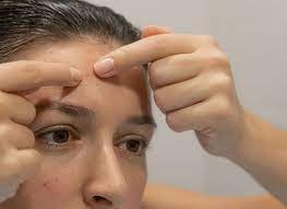 how to get rid of forehead pimples