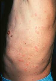 dermatologic signs of systemic disease