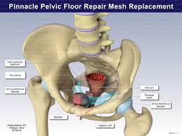 pinnacle pelvic floor repair mesh