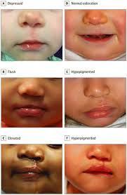 surgical repair of cleft lip