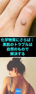 化学物質にさらば 素肌のトラブルは自然のもので解決する 素肌のトラブル解消 イボも自然な方法で取り除く イボ シミ 軟性繊維症 毛穴の黒ずみ ティーツリーオイル リンゴ酢 純粋はちみつ レモン汁 ちえとく イボ 治療 乾癬 イボ