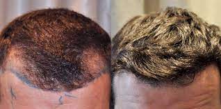 getting a temple hair transplant for