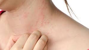Sama seperti campak biasa, rubella juga memicu munculnya bintik merah pada kulit tapi tidak gatal. Mencari Hubungan Ruam Kulit Dan Gejala Virus Corona