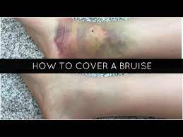 how to cover a bruise mikaelaabree