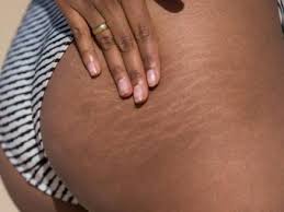 how to hide stretch marks 2 simple