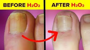hydrogen peroxide for nail fungus