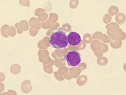 Acute Megakaryoblastic Leukemia Amkl M7 Flow Cytometry