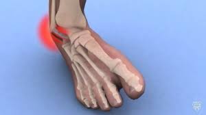 steps to a faster ankle sprain recovery