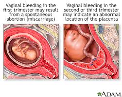 inal bleeding in pregnancy