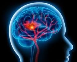 Homeopathy for cerebral ischemic stroke treatment ischemic stroke, symptoms, cause, investigations, or diagnosis, homeopathic medicine for cerebral ischemic stroke and treatment of. Ischemic Stroke Recovery And The Role Of Cerebral Gaba Activity Analyzedirect